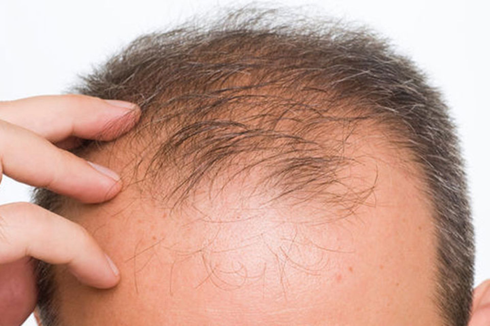 চুল পড়ার কারণ, অতিরিক্ত চুল পড়ার সমাধান।